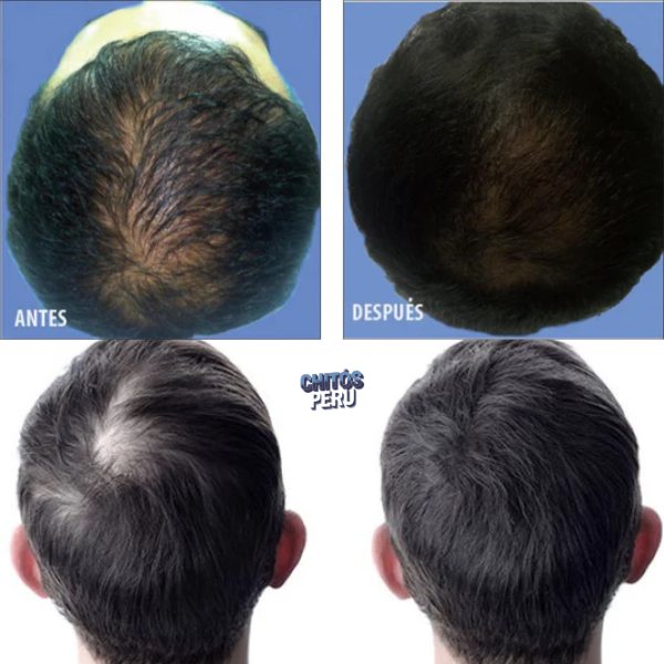 OUHOE -CRECIMIENTO DE CABELLO